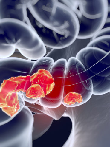 colorrectal